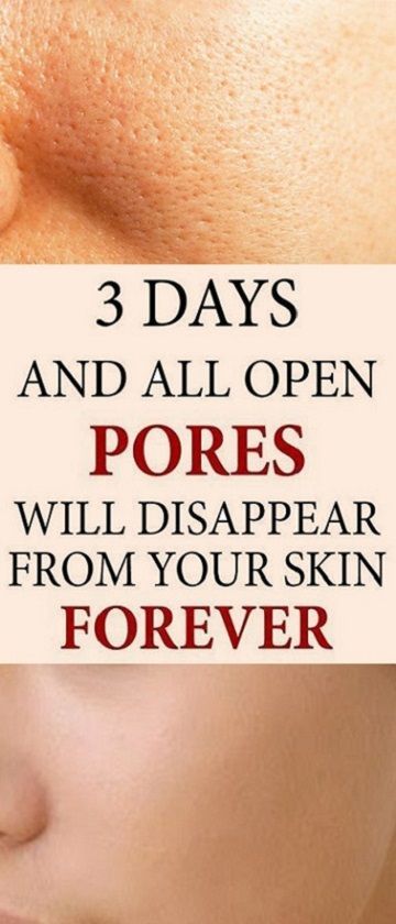 3 Days and All Open Pores Will Disappear from Your Skin Forever - DIY & Beauty -   13 skin care Blackheads apple cider vinegar ideas