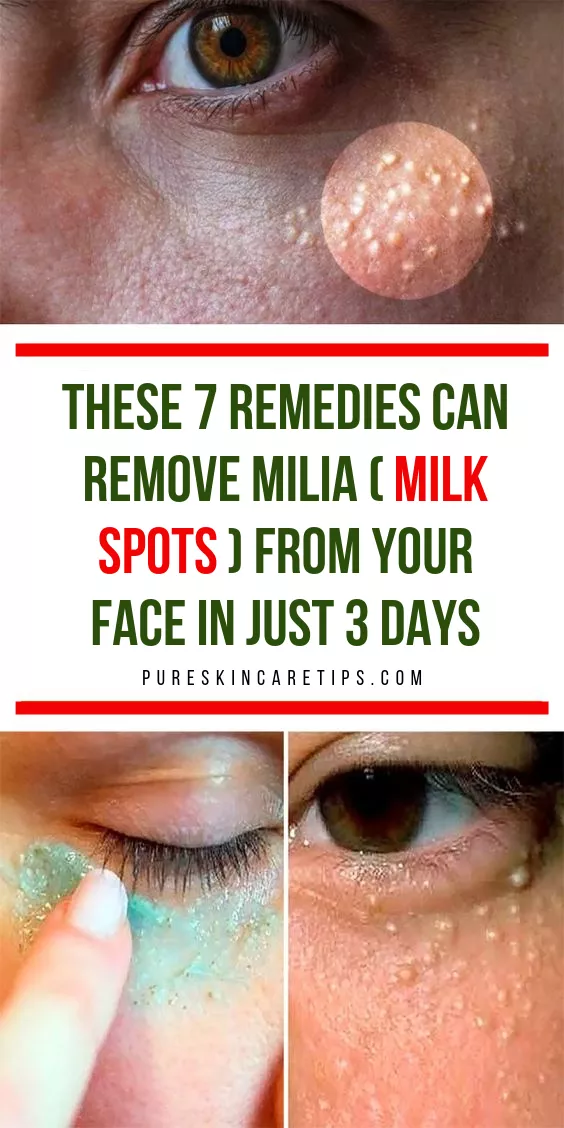Get Rid Of Milia Fast With These 7 Home Remedies -   9 skin care Remedies facials ideas