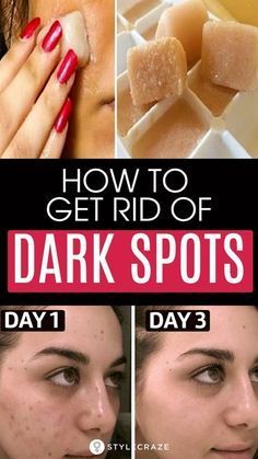 How To Remove Dark Spots On Face Fast: 6 Home Remedies -   11 skin care Remedies articles ideas
