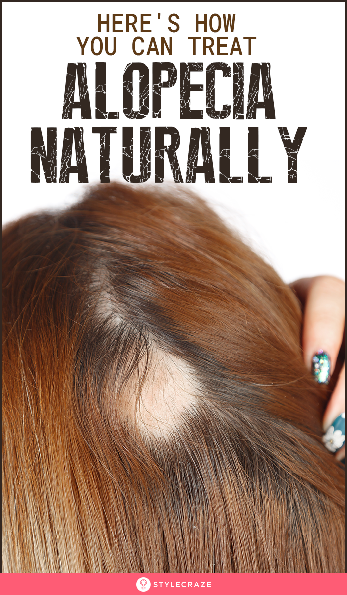 What Is Alopecia And How To Treat It Naturally -   15 hair Fall style ideas