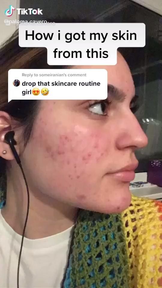 How to get rid of acne overnight -   25 skin care Tips videos ideas