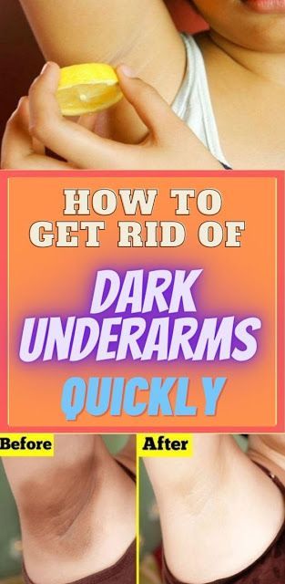How To Get Rid Of Dark Underarms Quickly -   15 how to get rid of dark underarms ideas