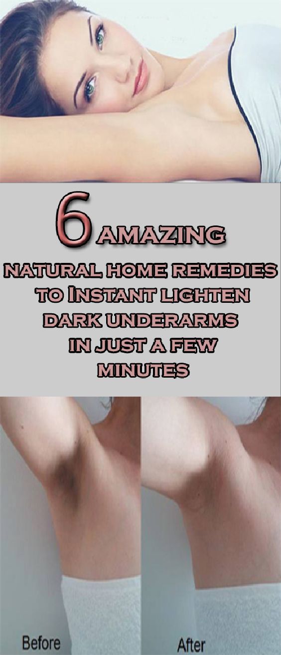 How To Lighten Dark Underarms At Home - Get Rid Of  Dark Underarms -   15 how to get rid of dark underarms ideas