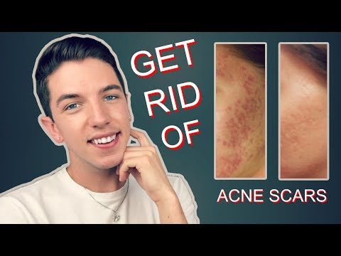 How to Get Rid Rid of Acne Scars Completely! -   18 how to get rid of acne scars ideas