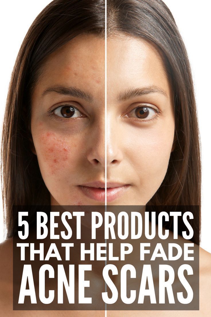 How to Get Rid of Acne Scars: 10 Products and Remedies to Try -   18 how to get rid of acne scars ideas