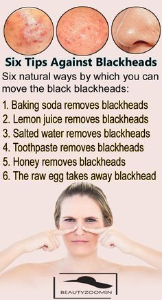 Six Tips Against Blackheads.Blackheads Can Be A Challenge For Skin -   19 beauty Tips products ideas