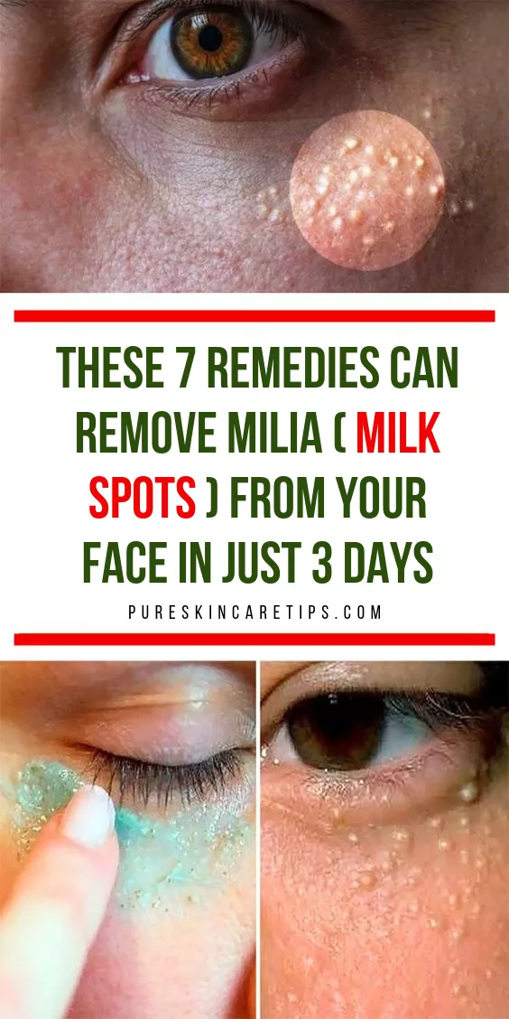 13-best-ways-to-get-rid-of-milia-milk-spots-2-6-are-best